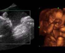 Échographie 4D d'un foetus de vingt semaines