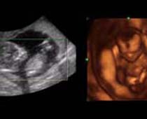 4D Ultrasound 16 weeks old fetus