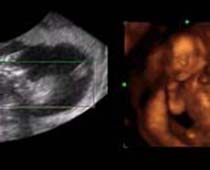 Vieux 4D ultrasons quinze semaines foetus