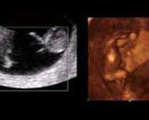 4D Ultrasound a 12 weeks old fetus