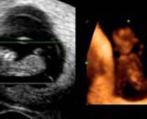 Échographie 4D d'un foetus âgé de dix semaines