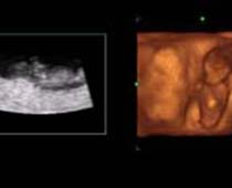 4D Ultrasound a Tiny Baby
