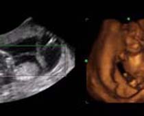 4D Ultrasound a fetus attempting to dance( Early Dancing )