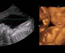 4D Ultrasound a fetus Smiling