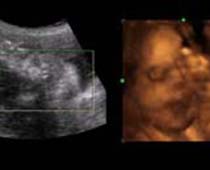 4D Ultrasound a fetus Tongue Out