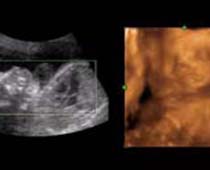 Échographie 4D un bâillement fœtus (bébé bâillement 2)