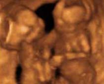 4D Ultrasound Twins Playing. Clip no 2