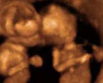 4D Ultrasound Twins Playing Clip no 1