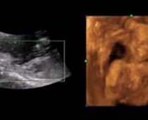 4D Ultrasound a Happy Fetus 2