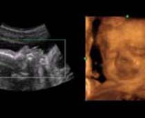 4D ultrasons expressions du visage d'un fetus.clip 2