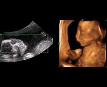 4D Ultrasound a Grumpy Baby