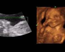 Échographie 4D une danse de fœtus (bébé de danse)