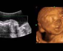 4D Ultrasound a fetus Stretching
