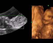 4D Ultrasound a fetus shouting.Clip no 3 Shouting Baby