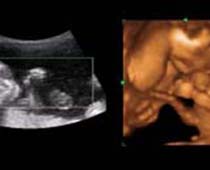 4D Ultrasound a Jumping boy