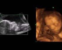 4D Ultrasound a sad fetus