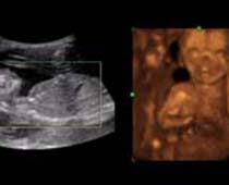 Échographie 4D un foetus jouant avec ses mains