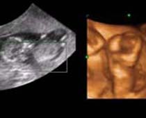 4D Ultrasound early sharing Life Together with the twin