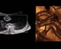 4D Ultrasound a nice view of the umbilical cord