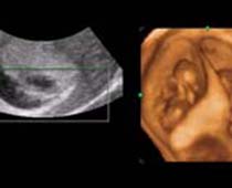 4D Ultrasound a 10 Weeks old Twins