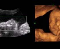 Échographie 4D un fœtus qui veut sortir