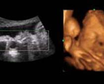 4D Ultrasound a fetus Sucking Lip