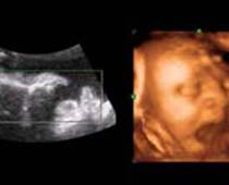 4D Ultrasound a fetus Yawning ( Baby Yawning )clip no 3