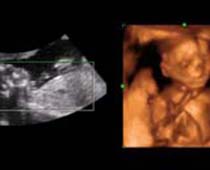 4D Ultrasound a fetus moving