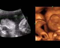Échographie 4D un bâillement fœtus (bébé bâillement), coupent pas 5