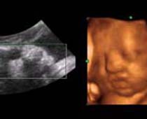 4D Ultrasound a fetus Drinking and swallowing, Clip no1