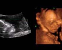 4D Ultrasound a fetus shouting.Clip no 1