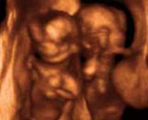 4D Ultrasound a 13 Weeks old Twins