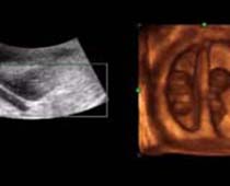 4D Ultrasound a 9+ Weeks old Twins