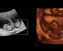 4D Ultrasound a 9+ Weeks old Triplets