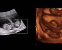 Échographie 4D A 9 semaines + Triplets