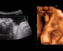 Échographie 4D fœtus sucer son pouce