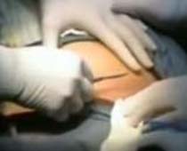 Video Cesarean Section Operation the complete operation (Cesarean delivery)