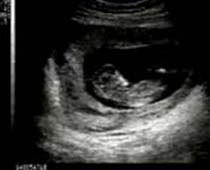 التراساوند ثنائي الابعاد مباشر لجنين في مراحل مبكرة من الحمل