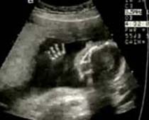 2-D ultrasons en direct de foetus en début de grossesse 2