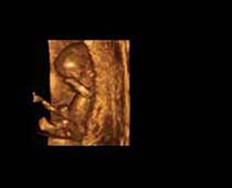 Échographie 3D de Premier Trimestre foetus 3