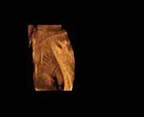 3D Ultrasound of Fetal Back