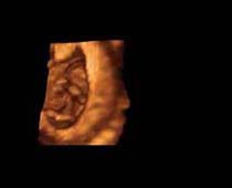 3D Ultrasound of First Trimester Fetus 6