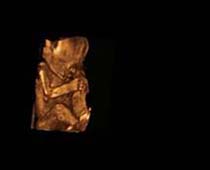 Échographie 3D de Second Trimestre foetus 8