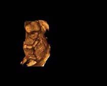 Échographie 3D de Second Trimestre foetus 9