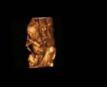 Échographie 3D de Premier Trimestre foetus 10