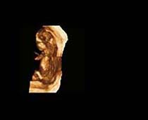 Échographie 3D de quatorze semaines foetus 4
