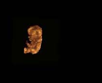 Échographie 3D de Premier Trimestre foetus 1