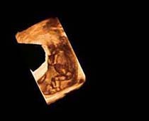 Échographie 3D de jambes fœtales