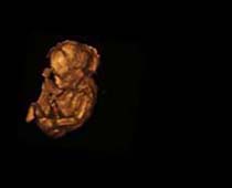 Échographie 3D de Second Trimestre foetus 3