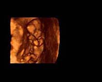 Échographie 3D de 13 semaines foetus